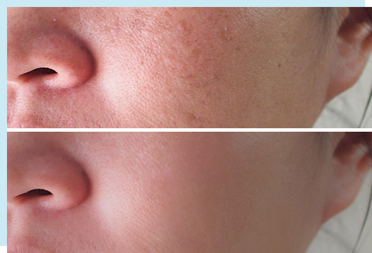 Mesolift anti acné